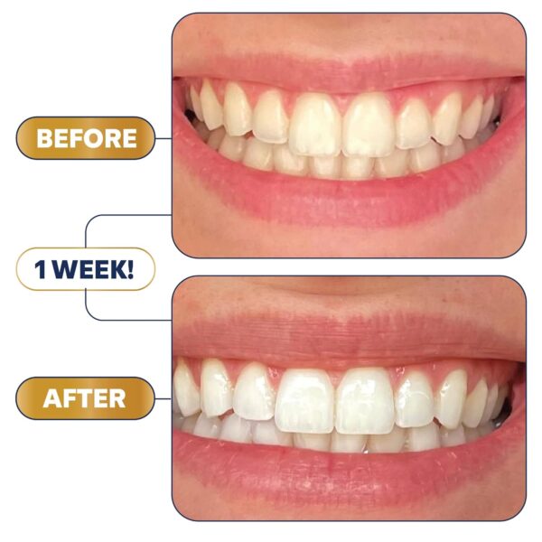 Lumineux Teeth Whitening Strips | Peroxide-Free & Enamel Safe | Dentist-Formulated Whitening Without Sensitivity | 9 Treatments - Image 7